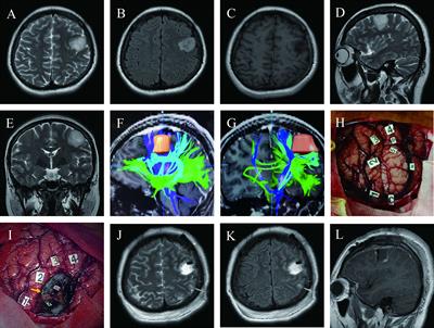 Maximal safe resection of diffuse lower grade gliomas primarily within central lobe using cortical/subcortical direct electrical stimulation under awake craniotomy